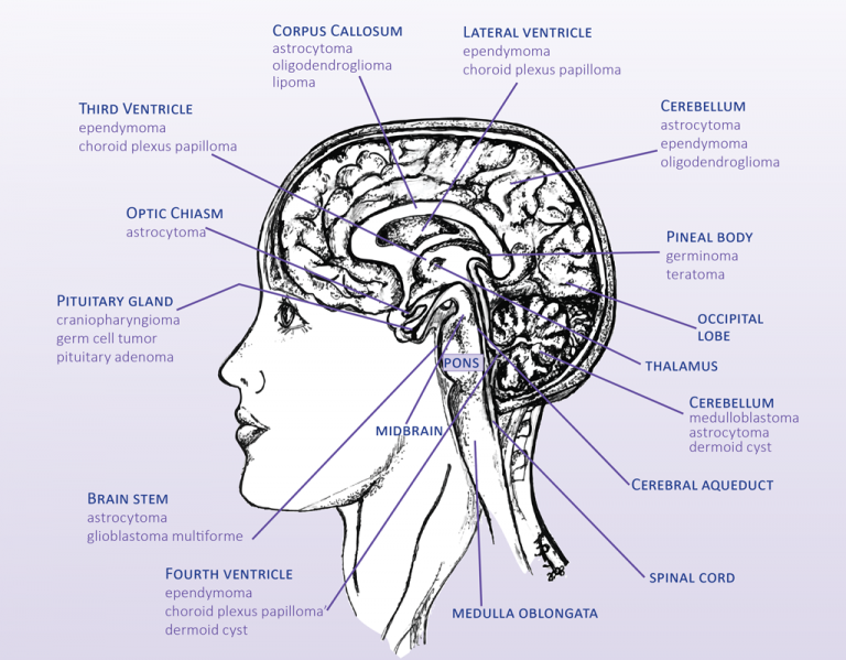 Medical Information - The Childhood Brain Tumor Foundation